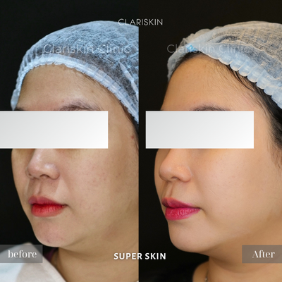 SuperSkin