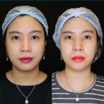 Before - BOTOX