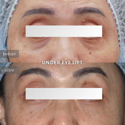 Under Eye Lift