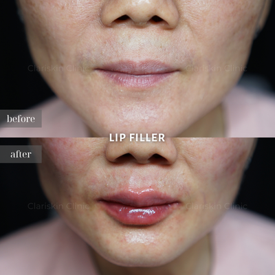 Before After Facelift Non-Surgical